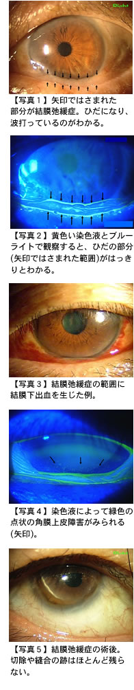 結膜弛緩症について