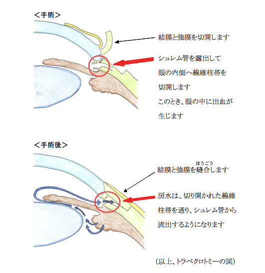 線維柱帯切開術