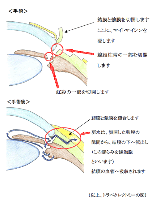 線維柱帯切除術