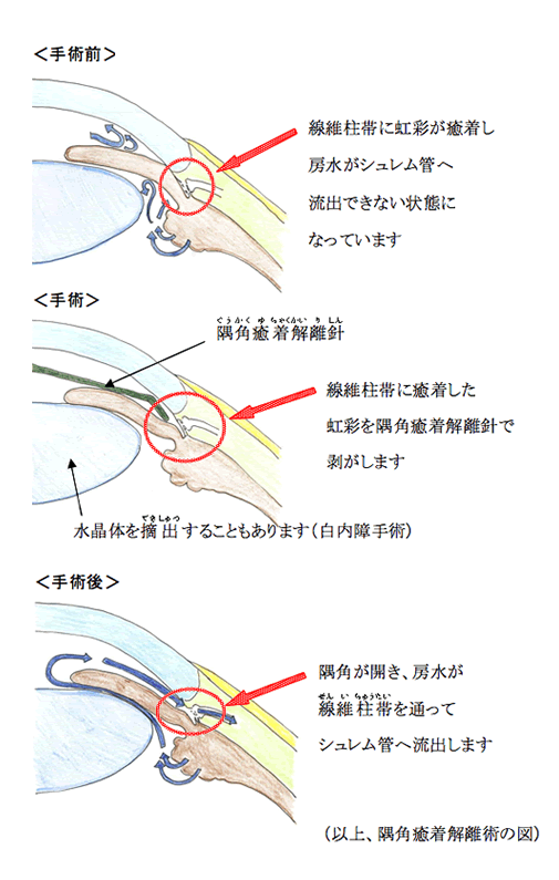 隅角癒着解離術