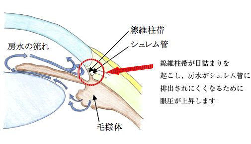 原発開放隅角緑内障