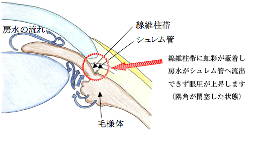 原発閉塞隅角緑内障