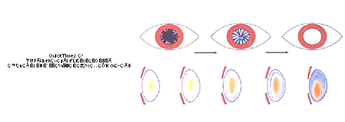 白内障について