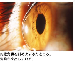 円錐角膜を斜めより見たところ。角膜が突出している。